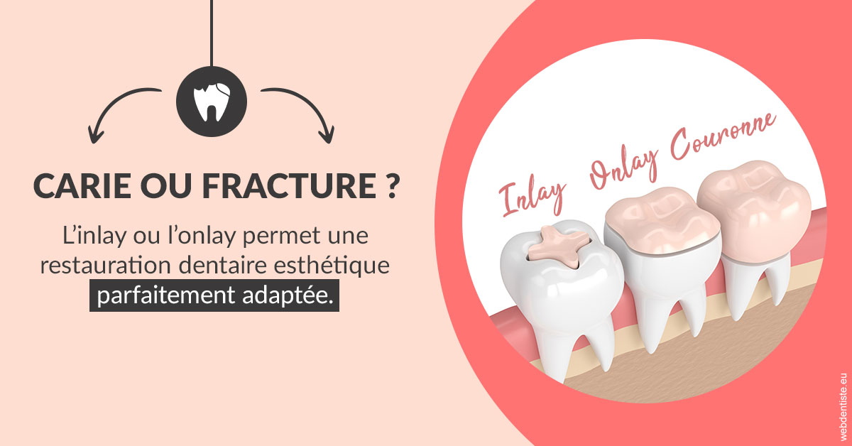 https://dr-opoka-jm.chirurgiens-dentistes.fr/T2 2023 - Carie ou fracture 2