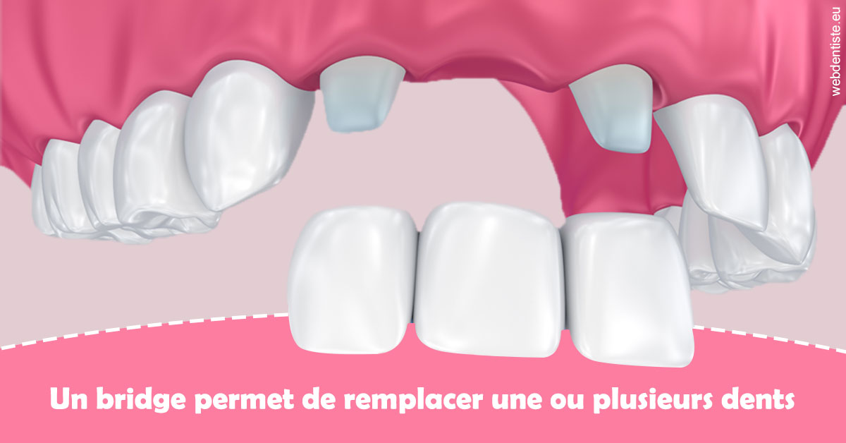 https://dr-opoka-jm.chirurgiens-dentistes.fr/Bridge remplacer dents 2