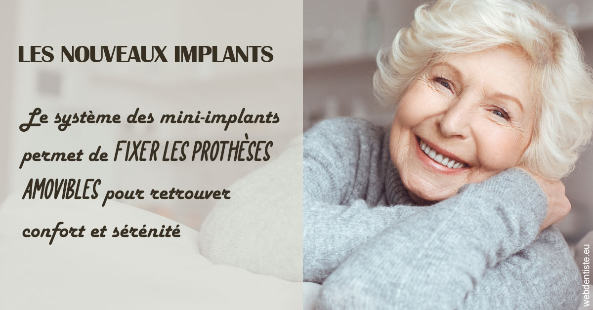 https://dr-opoka-jm.chirurgiens-dentistes.fr/Les nouveaux implants 1
