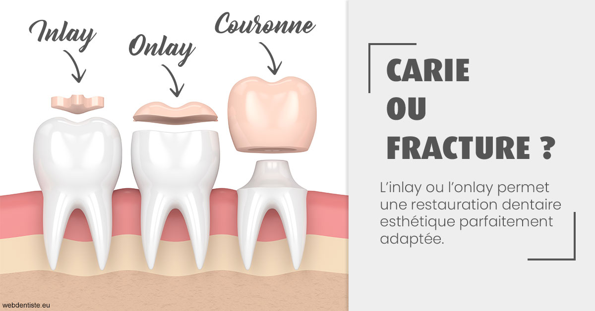https://dr-opoka-jm.chirurgiens-dentistes.fr/T2 2023 - Carie ou fracture 1