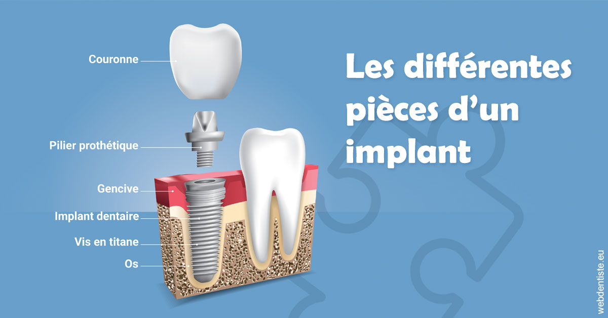 https://dr-opoka-jm.chirurgiens-dentistes.fr/Les différentes pièces d’un implant 1